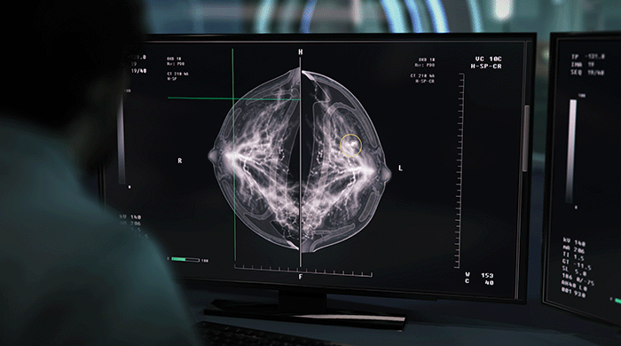 Radiologist reporting breast scan